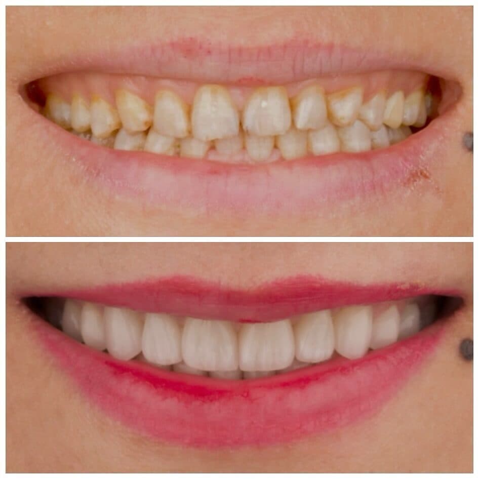Porcelain veneers, قبل وبعد، من عمل د. زين دزيي (case 2)