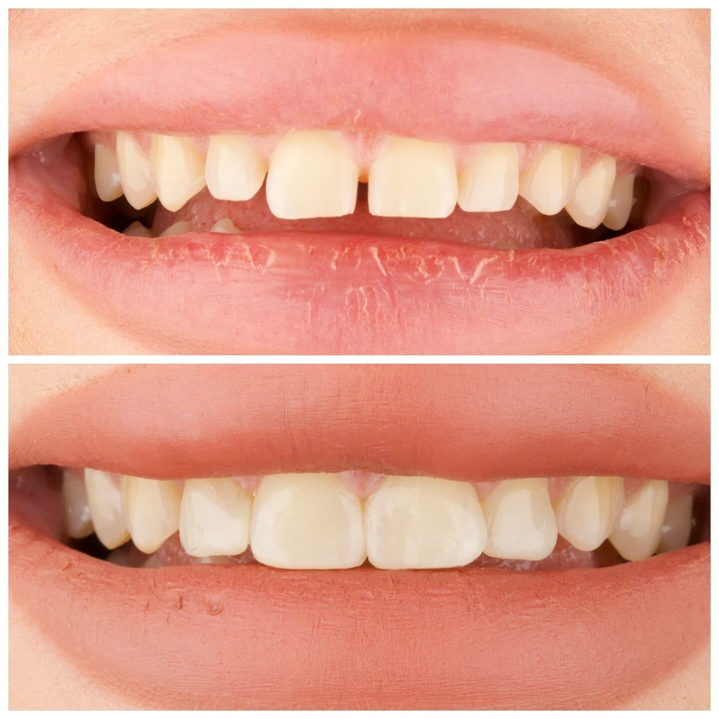 Composite bonding (gap closure), قبل وبعد، من عمل د. زين دزيي (case 4)
