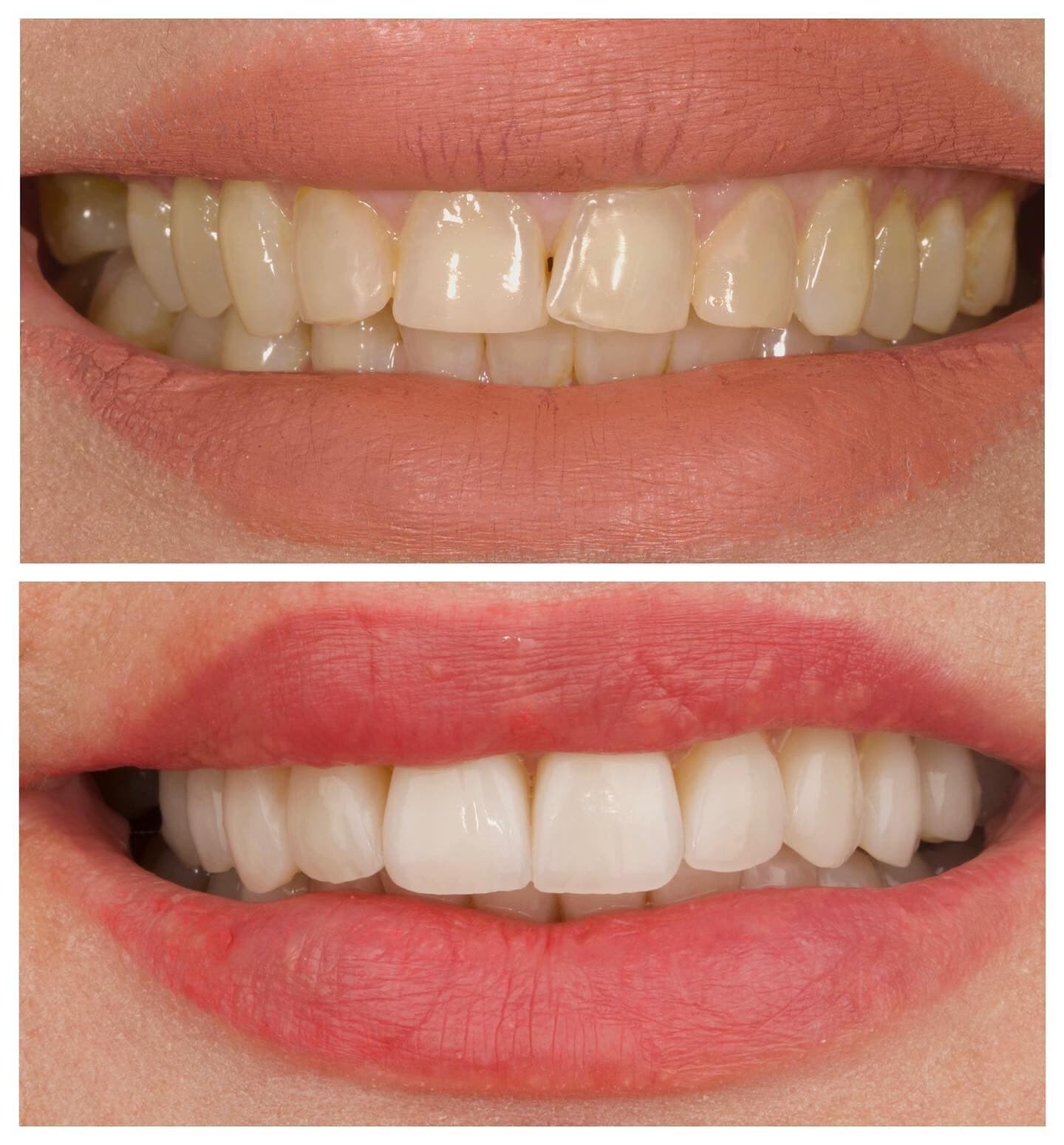 Porcelain veneers, قبل وبعد، من عمل د. زين دزيي (case 8)