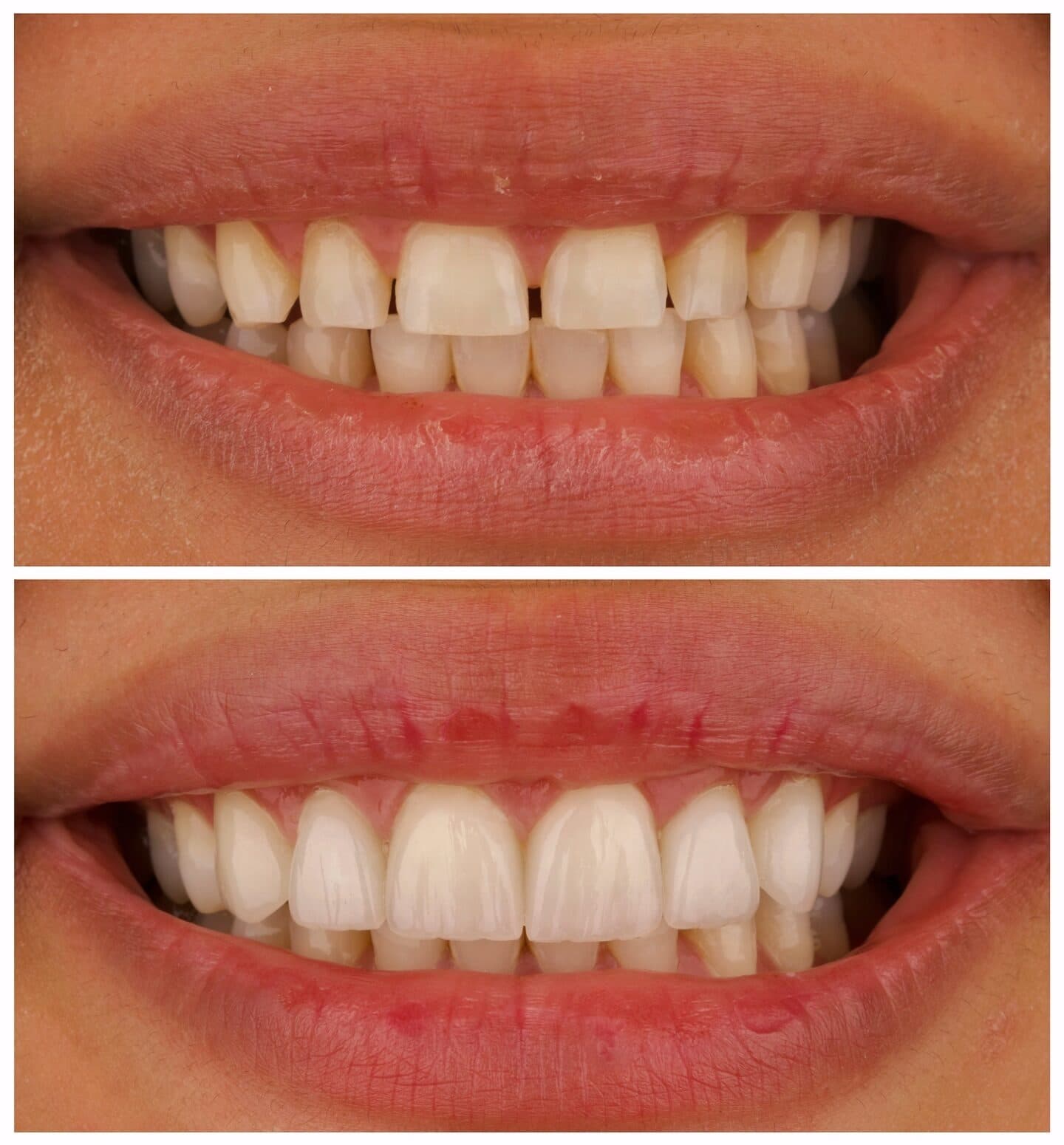 Porcelain veneers, قبل وبعد، من عمل د. زين دزيي (case 9)