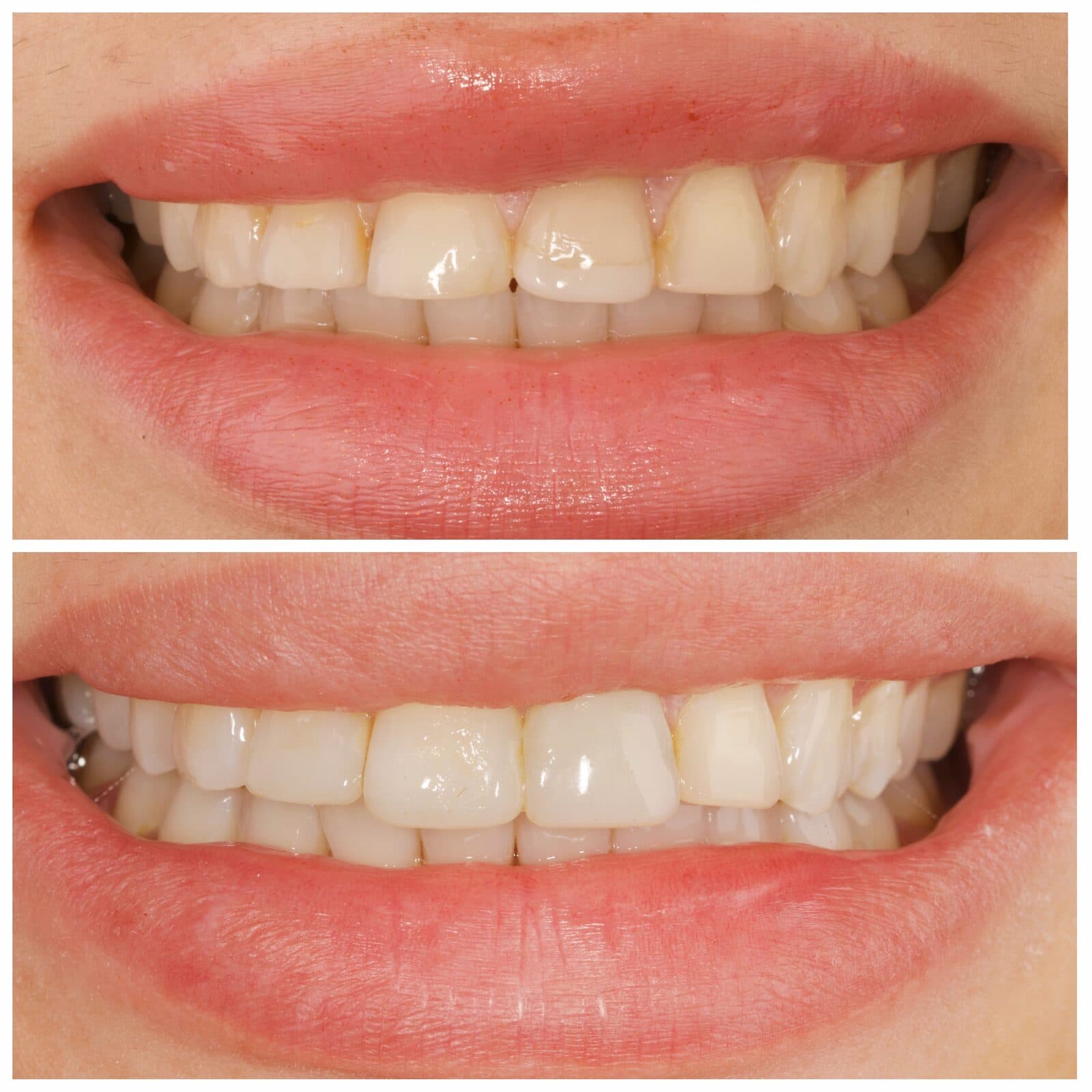Composite bonding & whitening, قبل وبعد، من عمل د. زين دزيي (case 10)