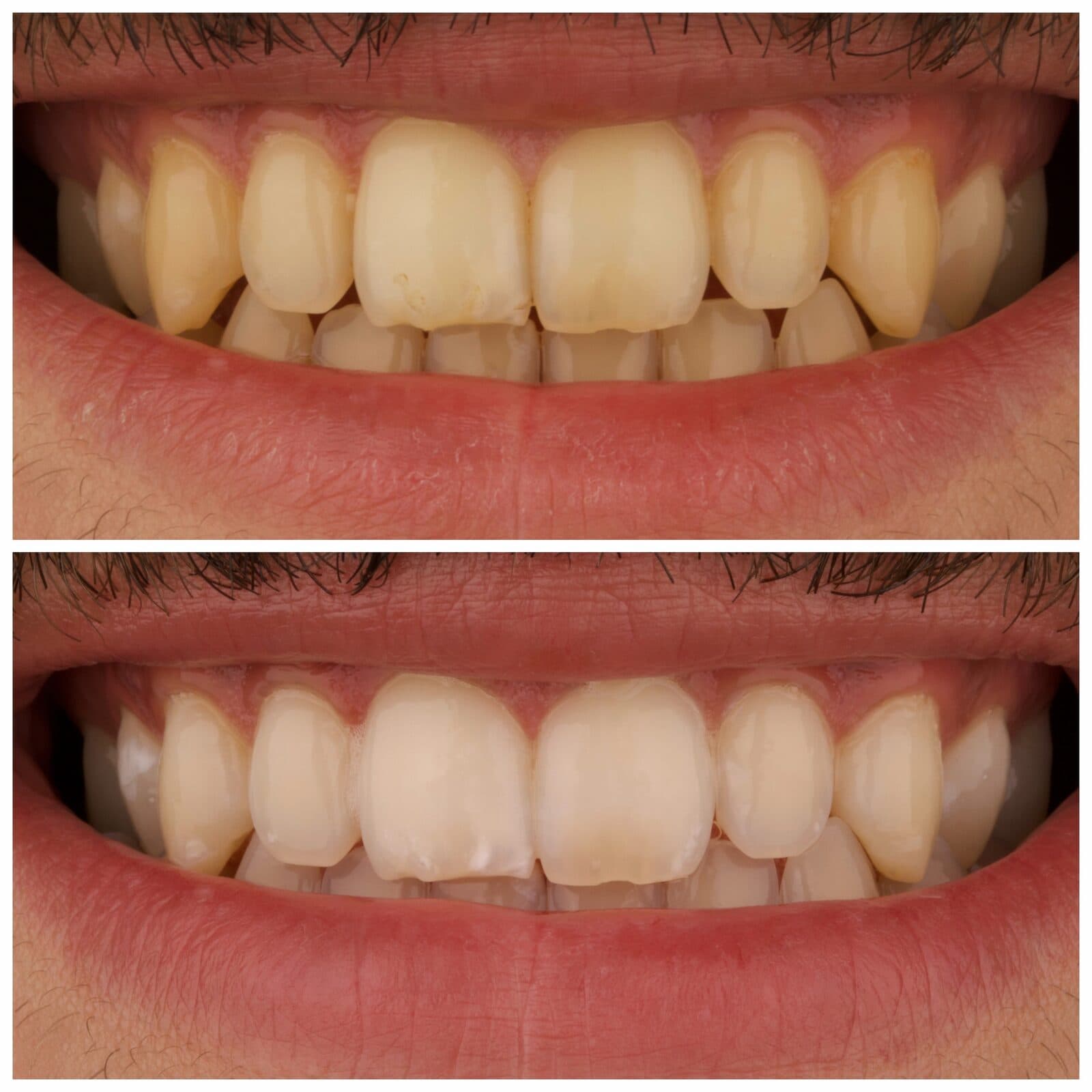 Teeth whitening, قبل وبعد، من عمل د. زين دزيي (case 11)